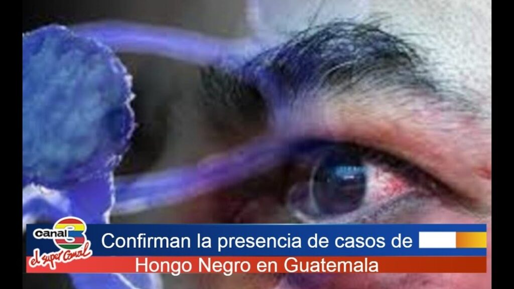 hongo negro llega a guatemala detectan primeros casos cdJl8PWiLks