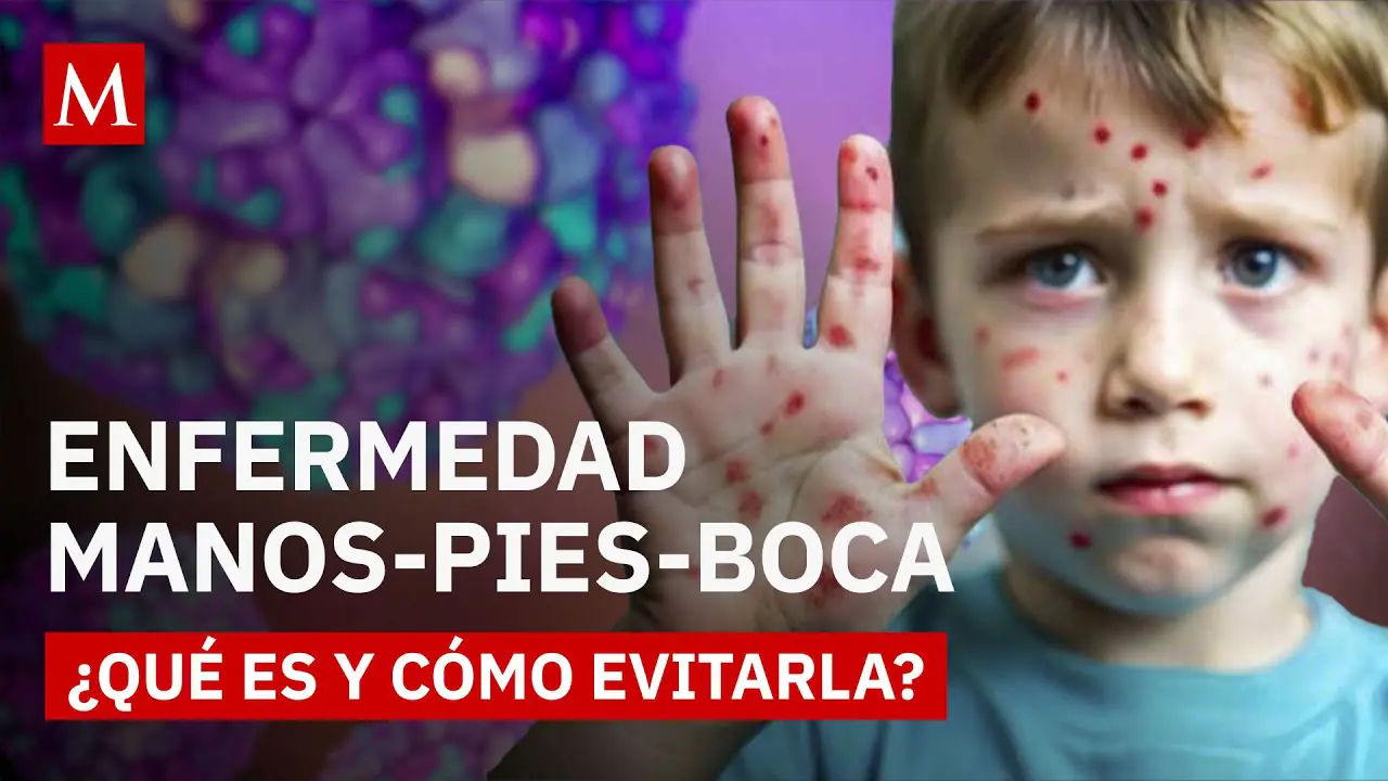 Enfermedad de mano pie y boca en niños: síntomas y cuidados en Guatemala 40 que es la empb todo lo que debes saber sobre la enfermedad que va en aumento